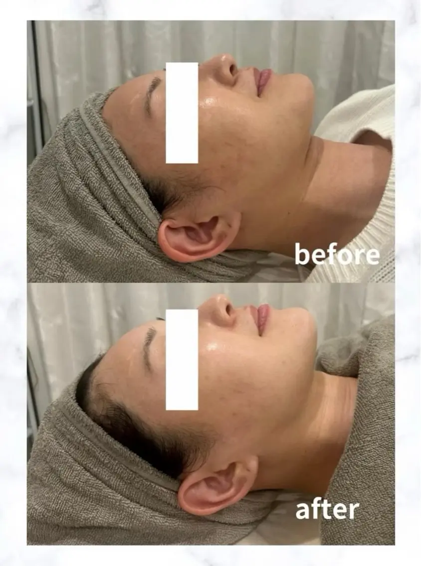 ⭐︎美白メニュー【乾燥やくすみが気になる方へ】最新の韓国プラピールで驚く程の美白ツヤ肌!16,000円→12800円の写真