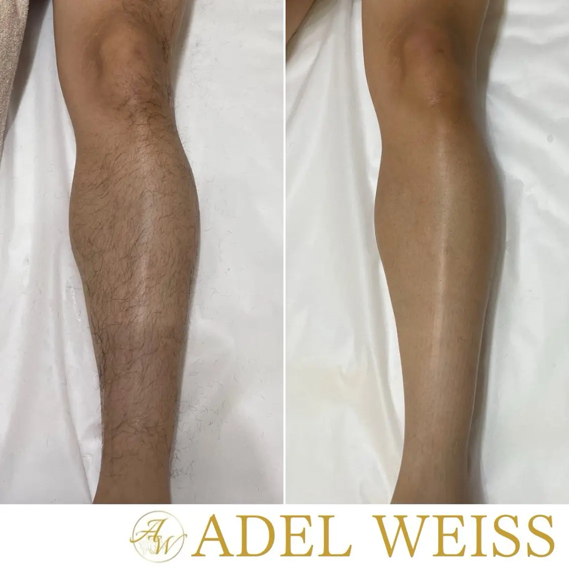 脱毛 ADEL WEISS 脱毛&毛穴&リンパのその他イメージ