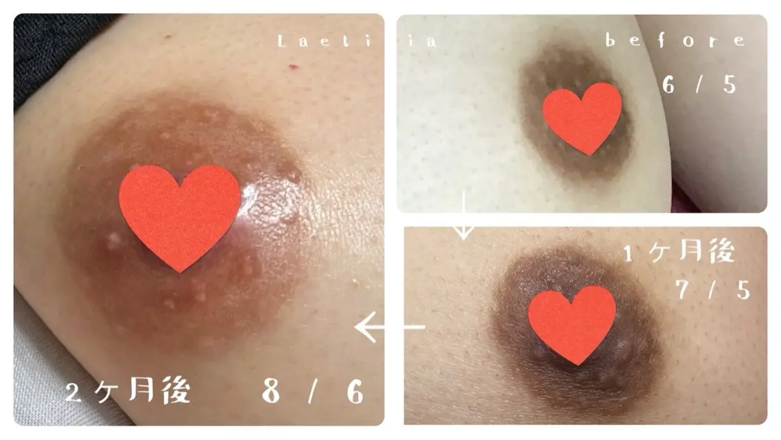 【6月末まで特別キャンペーン価格✨】ローマピンク🌸乳輪(バストトップ)の写真