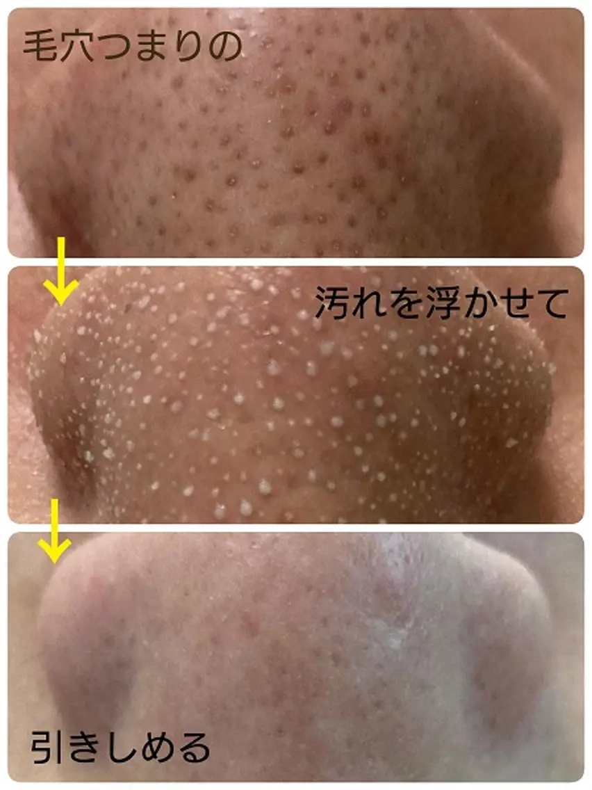 【話題沸騰！ニキビ•皮脂•テカリ】ハイパワー毛穴洗浄　全顔の写真