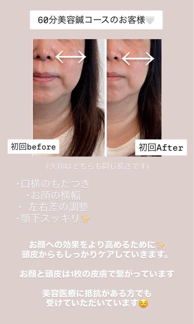エステ リラク 益吉 未来音 美容鍼/ 首肩こりのエステ・リラクイメージ