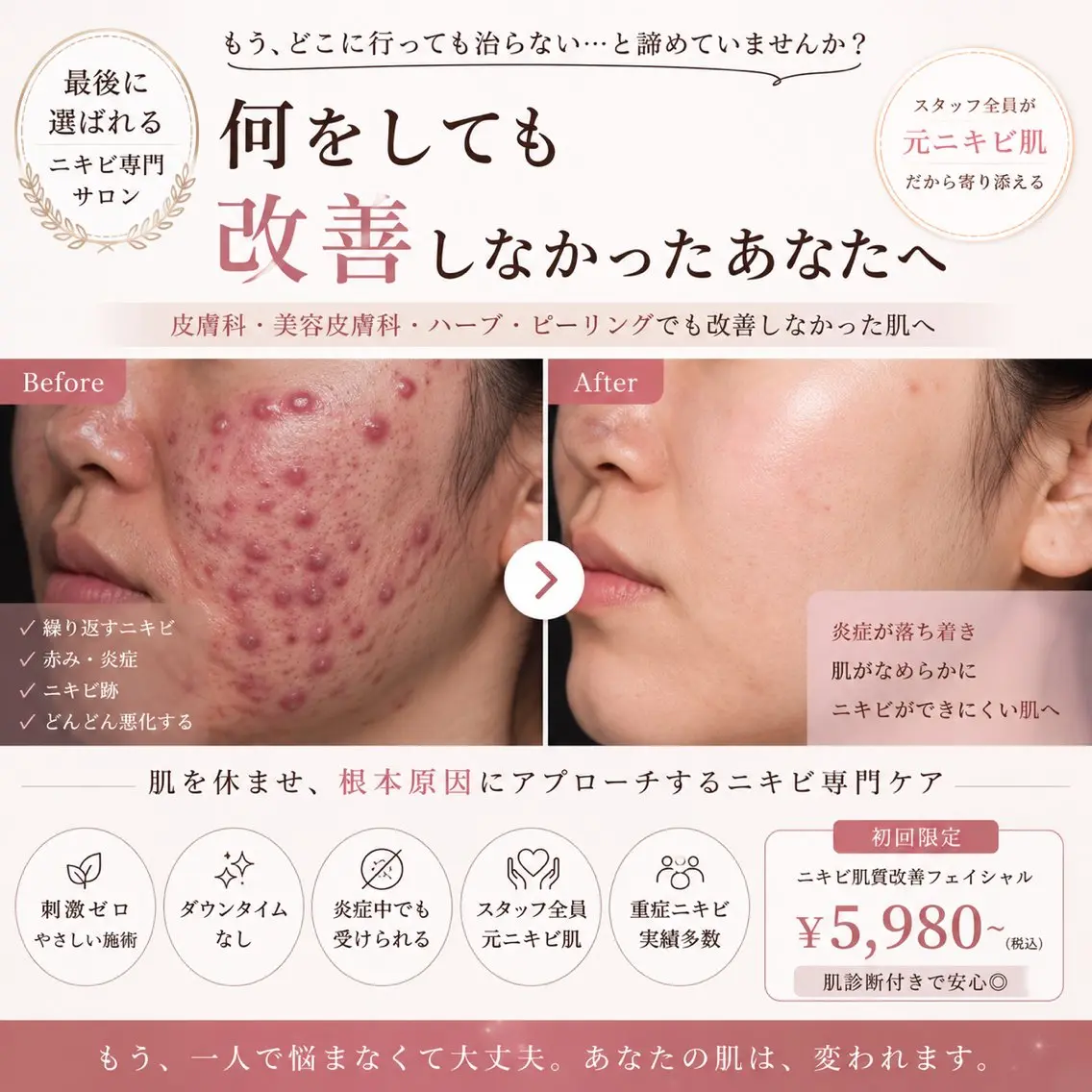 【何をしても改善しなかった方へ】刺激ゼロで肌を休ませながら改善|最後に選ばれる重度ニキビ特化ケア🔥の写真