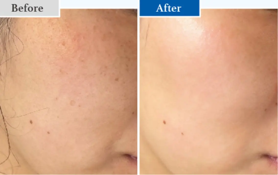 【35歳以上限定】最新ピーリングでエイジングケア💆‍♀️ダクトピール40分【顔撮影あり/要事前決済/すぐ予約不可】の写真