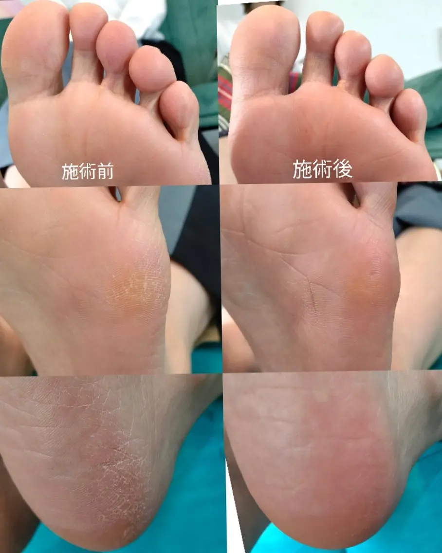 フット角質ケアの写真
