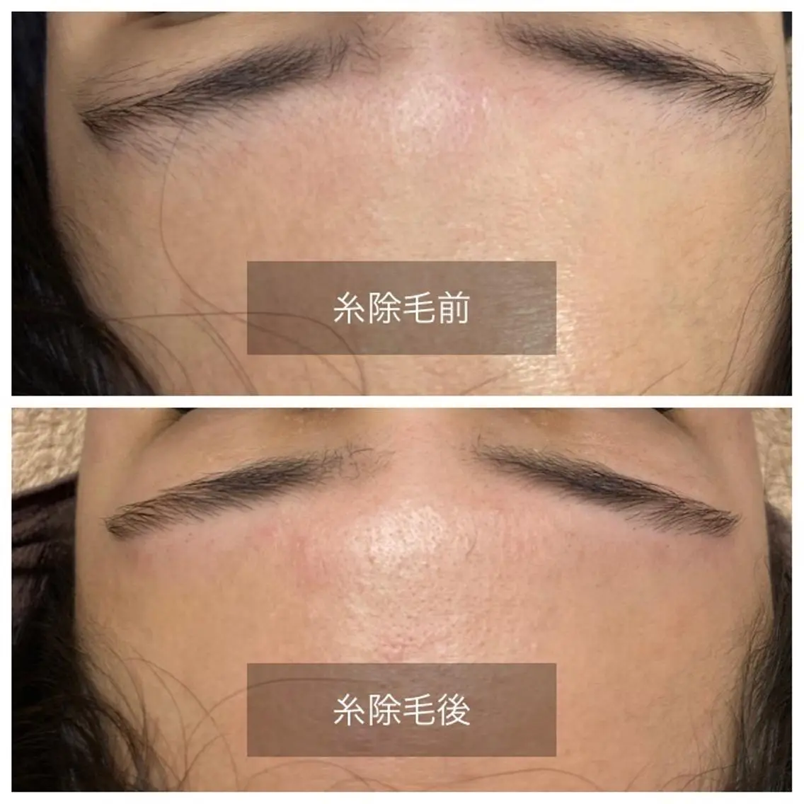 おでこ糸脱毛　糸一本のみの写真