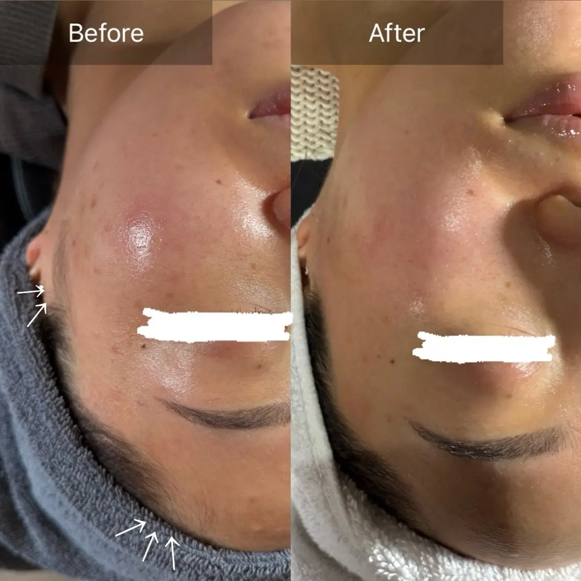 脱毛 enine フェイスWAXのエステ・リラクイメージ