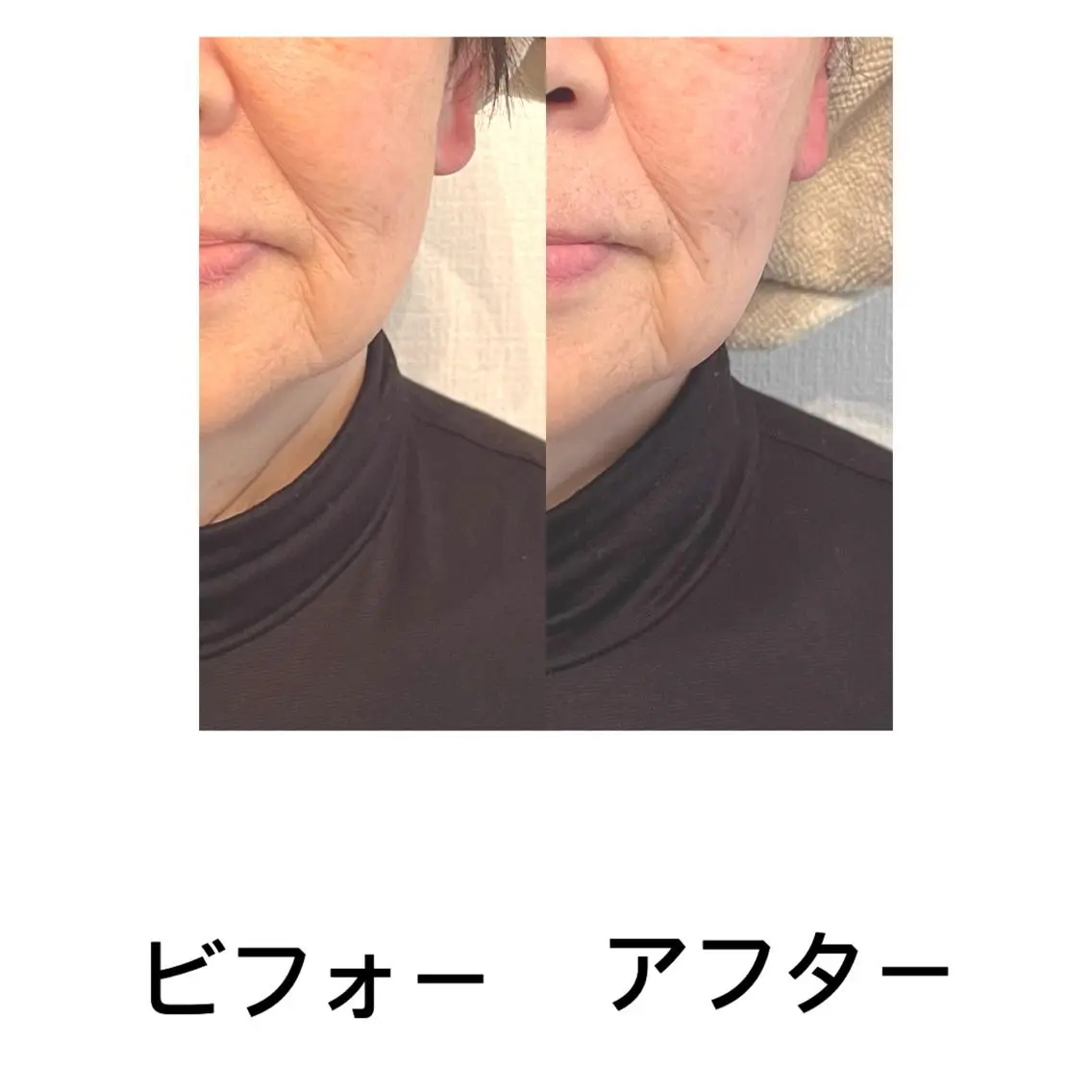 悩み別フェイシャルコース60分　　　肌悩みに合わせて使う美顔器が選べます。の写真