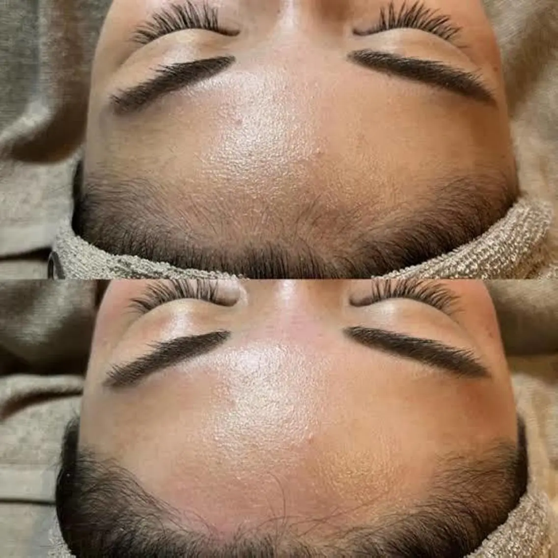 夏に向けて🌺おでこWAX脱毛 練習モデル様募集中!の写真