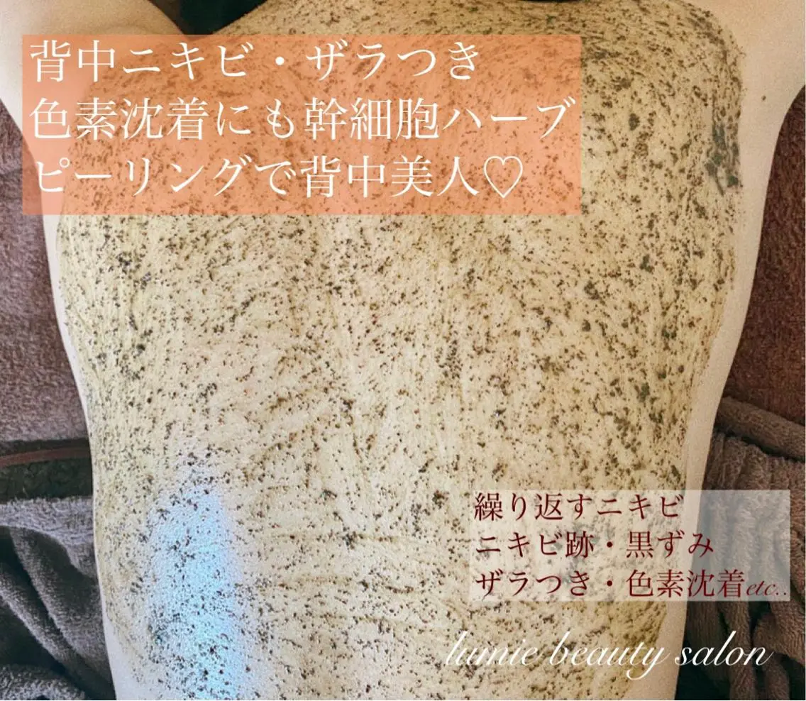 本気で肌荒れを治したい方にオススメ❣️剥けない幹細胞ハーブピーリング【背中】2gの写真