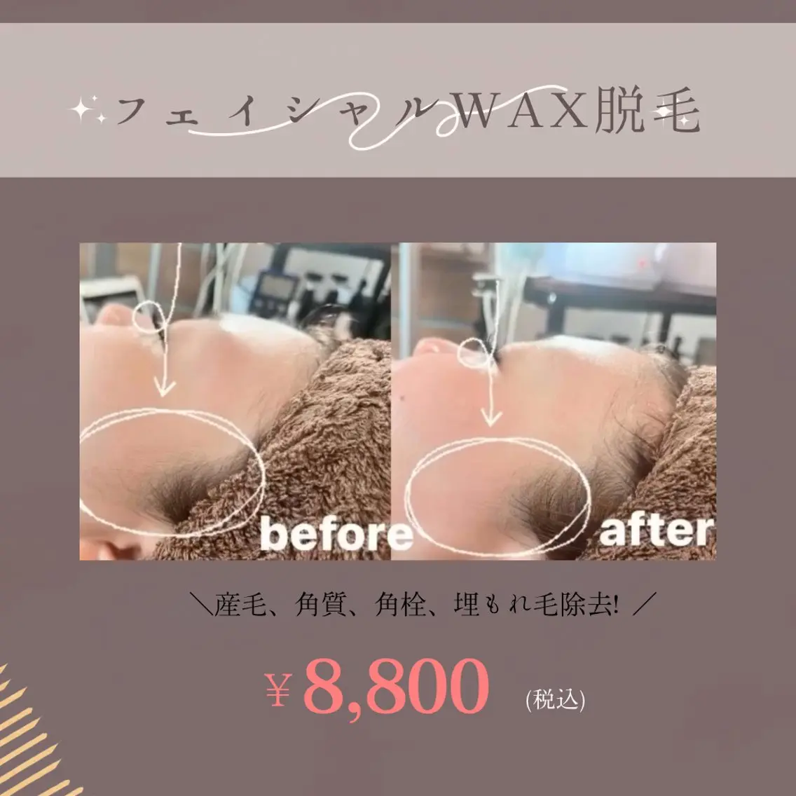 フェイシャルトリートメントwax脱毛の写真