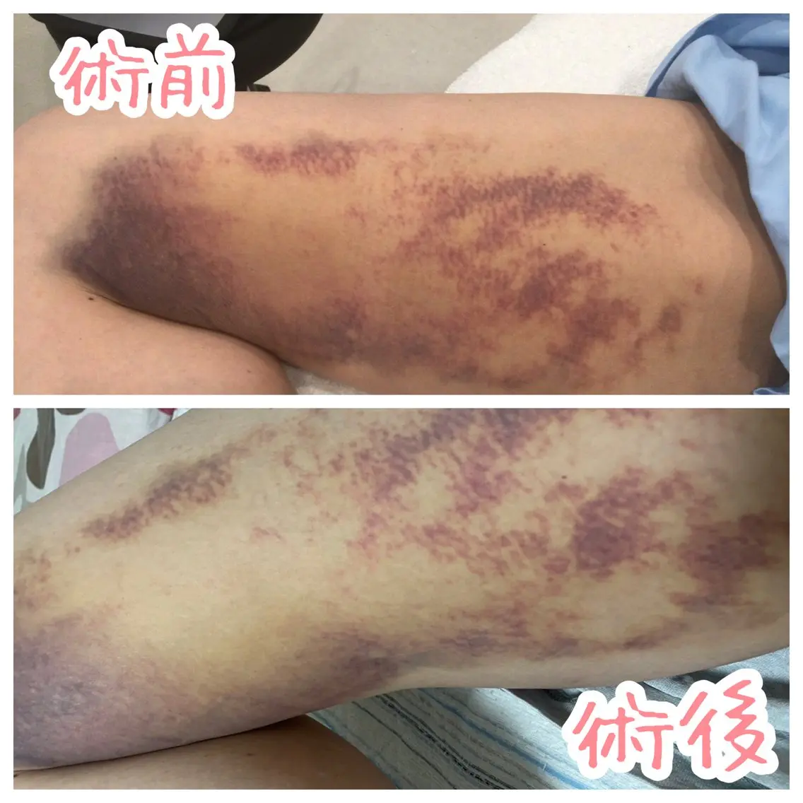 【部位写真+口コミ必須】整形・脂肪吸引後の拘縮・むくみ緩和に✨術後DTインディバ 30分の写真