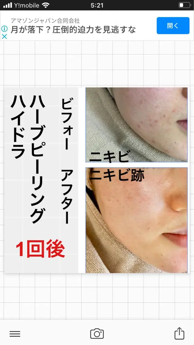 今月限定‼️ブライダルプラン39800👰💒✨最高級ハーブピーリング🌿顔首デコルテ、うなじ、背中、腕 部位変更可✨の写真