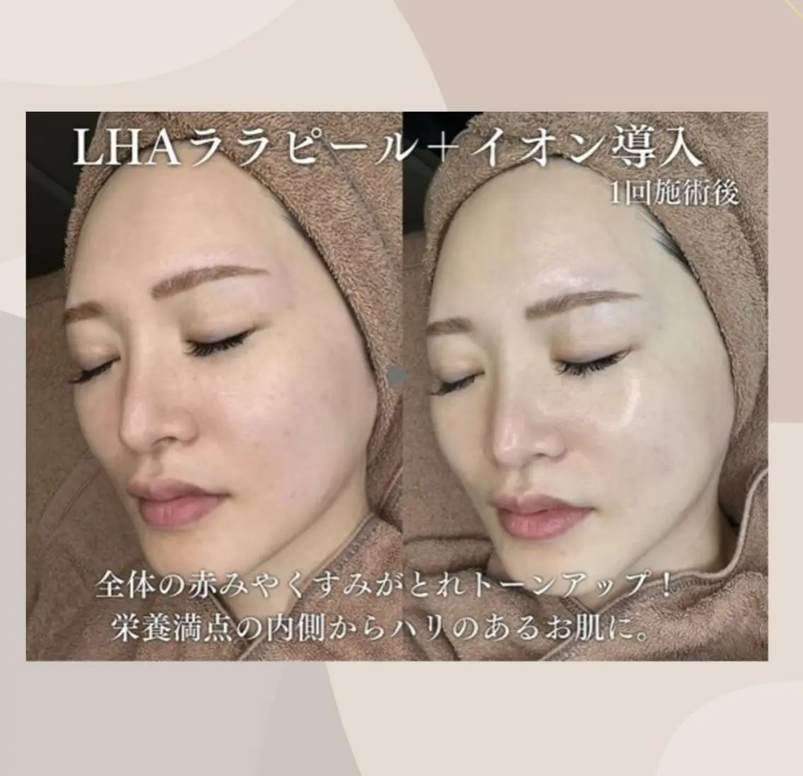 1〜4日限定価格‼️ 🌸韓国で大人気🌙【ララピール】⚠️注意事項確認必須の写真