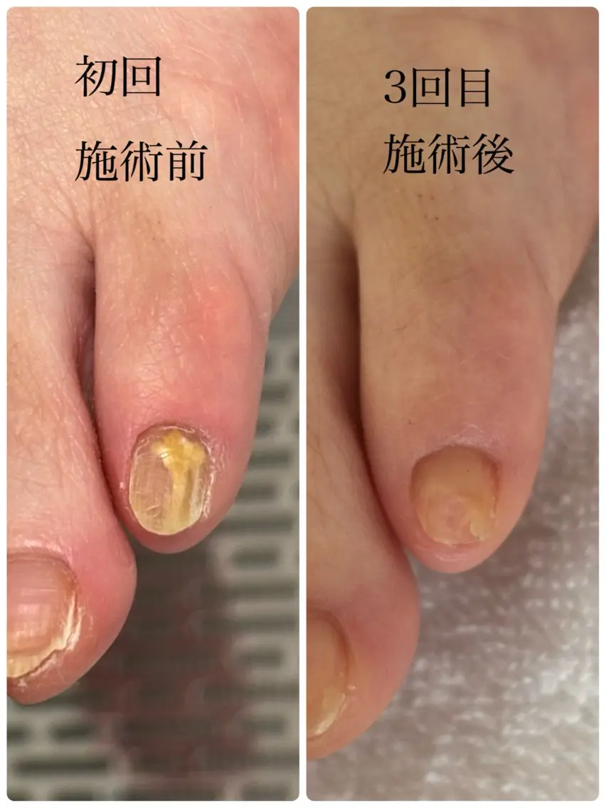 足元の菌トラブルに徹底アプローチ✨ 清潔感を取り戻す“菌バスターケア”の写真