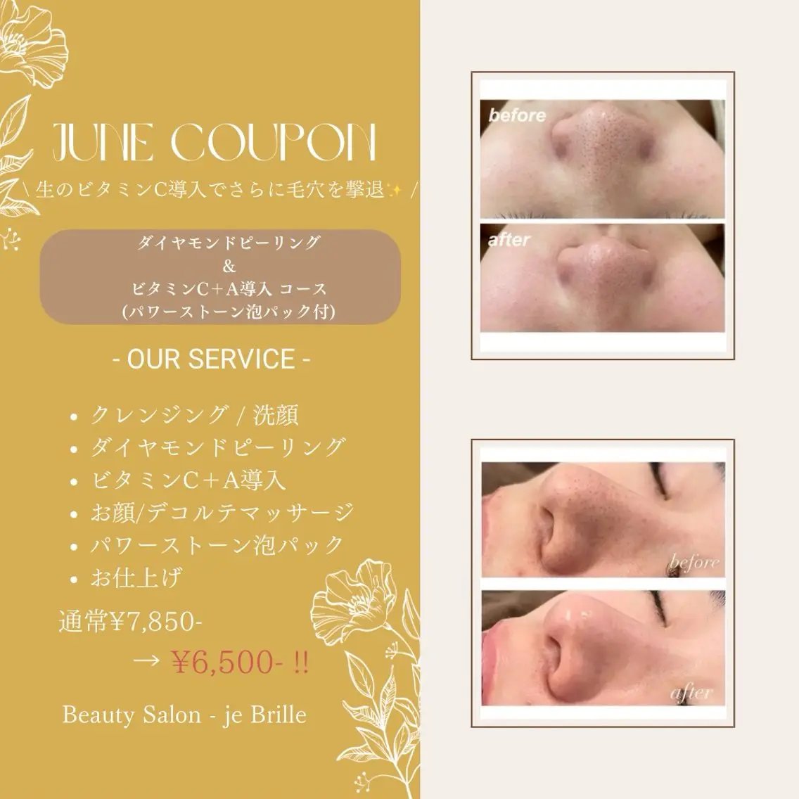 毛穴の黒ずみ/くすみ解消！！ダイヤモンドピーリング＋ビタミンC導入＋泡パック🫧の写真