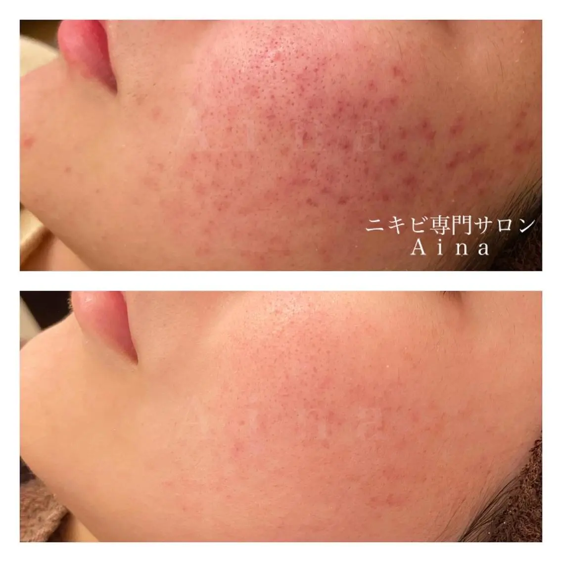 セミロング カラー パーマ ヘアアレンジ メンズ キッズ ネイル マツエク・マツパ 赤色 エステ リラク ニキビ跡専門サロン Ａｉｎａのエステ・リラクイメージ