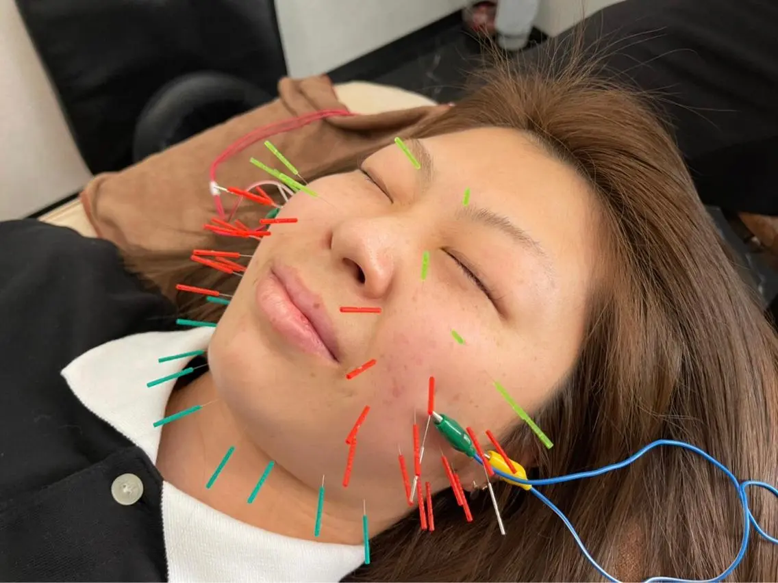 その他 小顔矯/美容鍼/鍼灸 BeauJuのその他イメージ