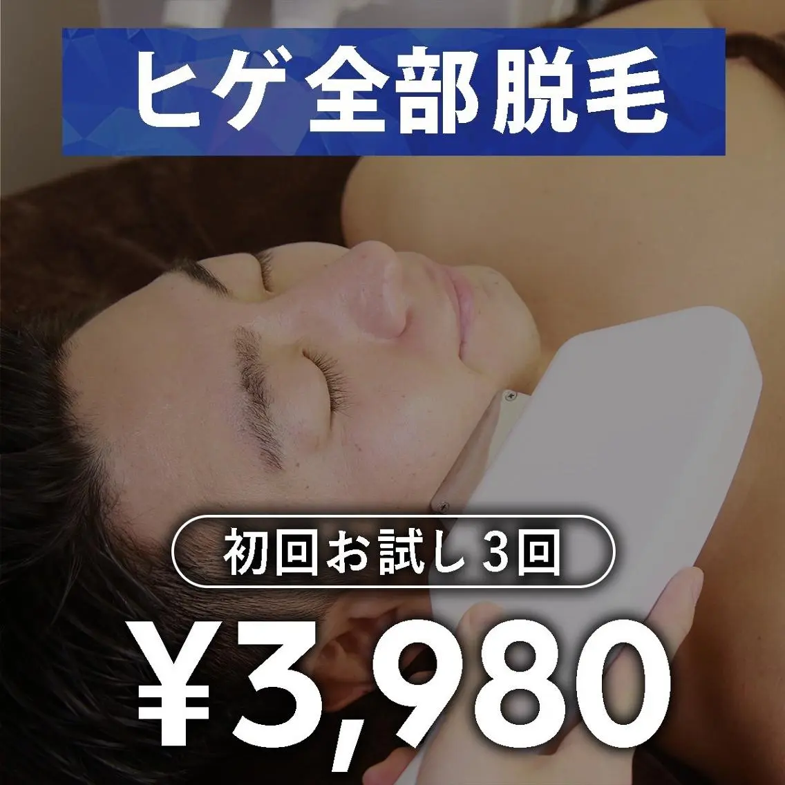 【メンズ脱毛】ヒゲ脱毛初回お試し　3回の写真