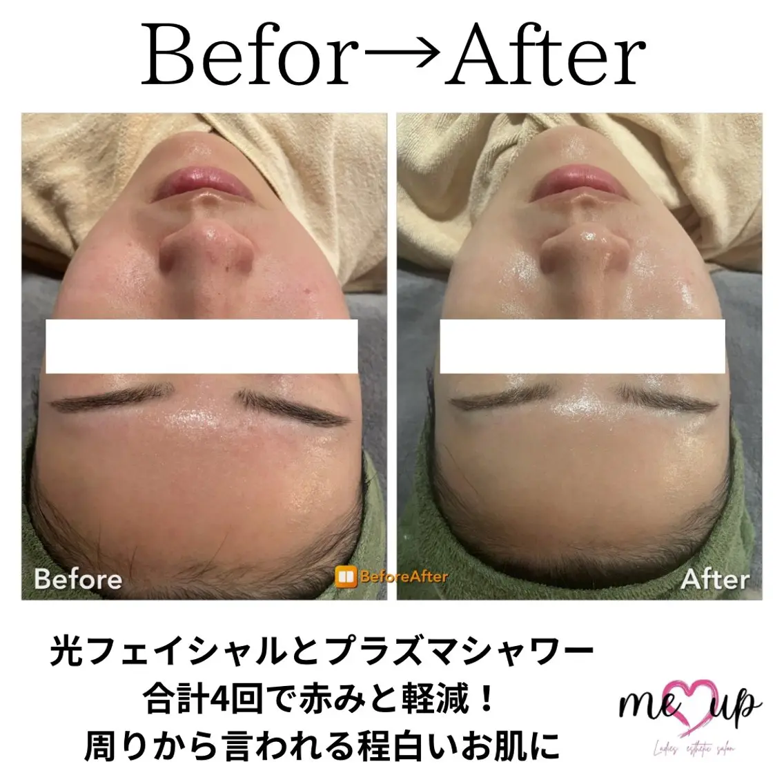 エステ Meupニキビ専門店 背中/ハーブ/肌管理のその他イメージ