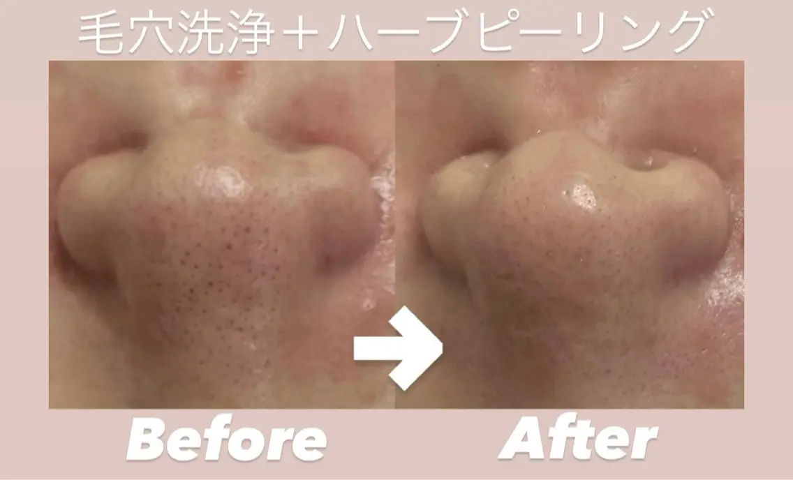 🌟ご新規様限定🌟【毛穴洗浄＋ハーブピーリング】　黒ずみ/開き毛穴汚れスッキリ！ツルツルで触りたくなるお肌へ🪞✨の写真