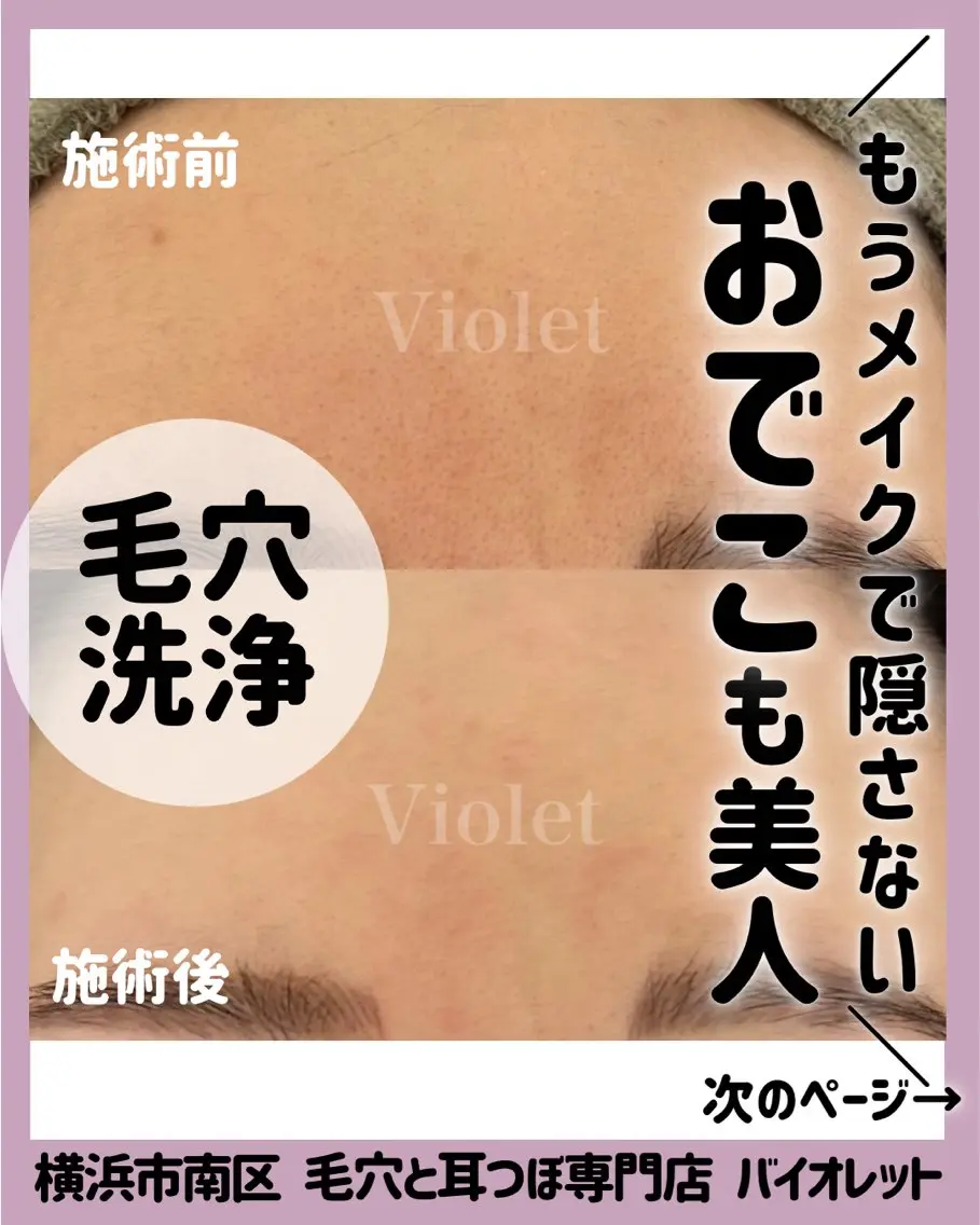 その他 毛穴と耳つぼ専門店 バイオレット　りののその他イメージ