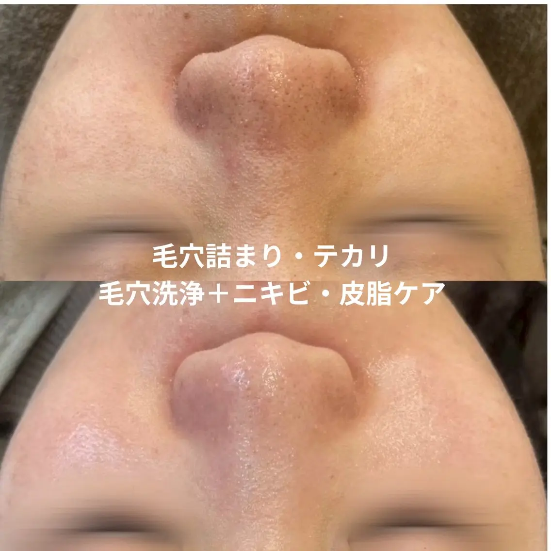 【初回】毛穴洗浄+ニキビ・皮脂ケア🫧毛穴詰まり・テカリ対策の写真