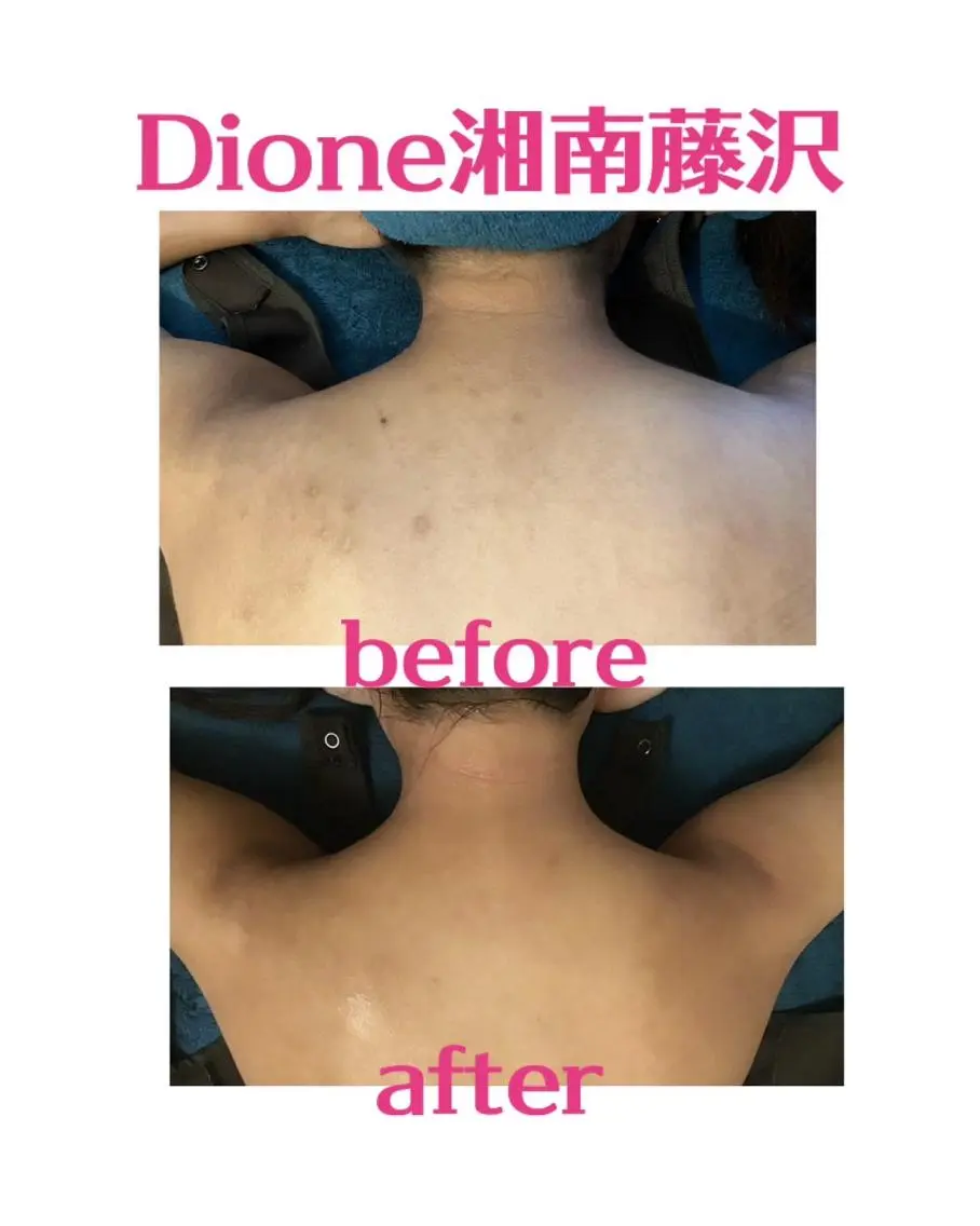 ☆キレイな背中〈脱毛×背中ニキビケア〉☆の写真