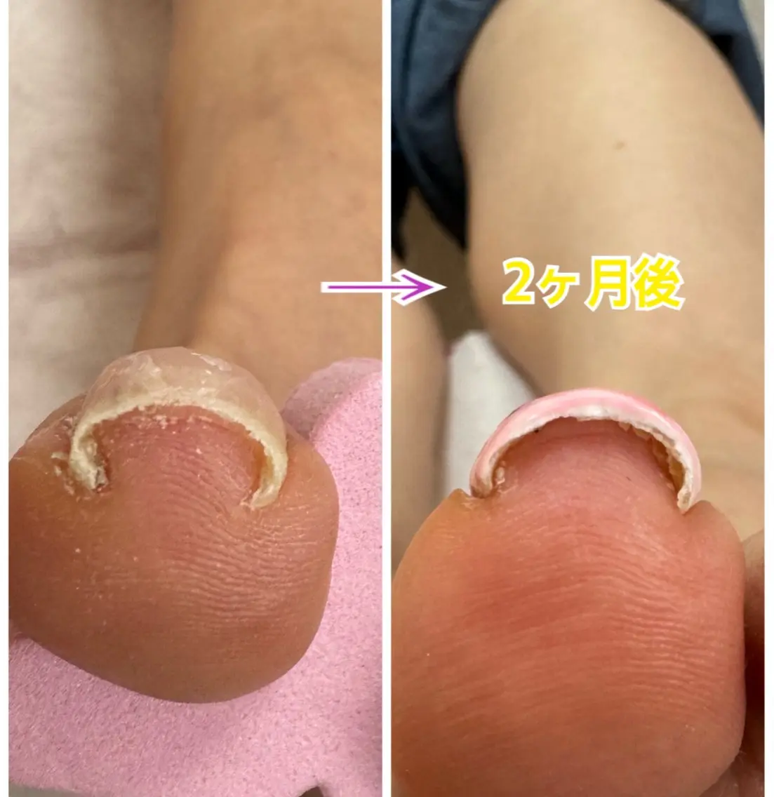 巻き爪補正フットネイルの写真