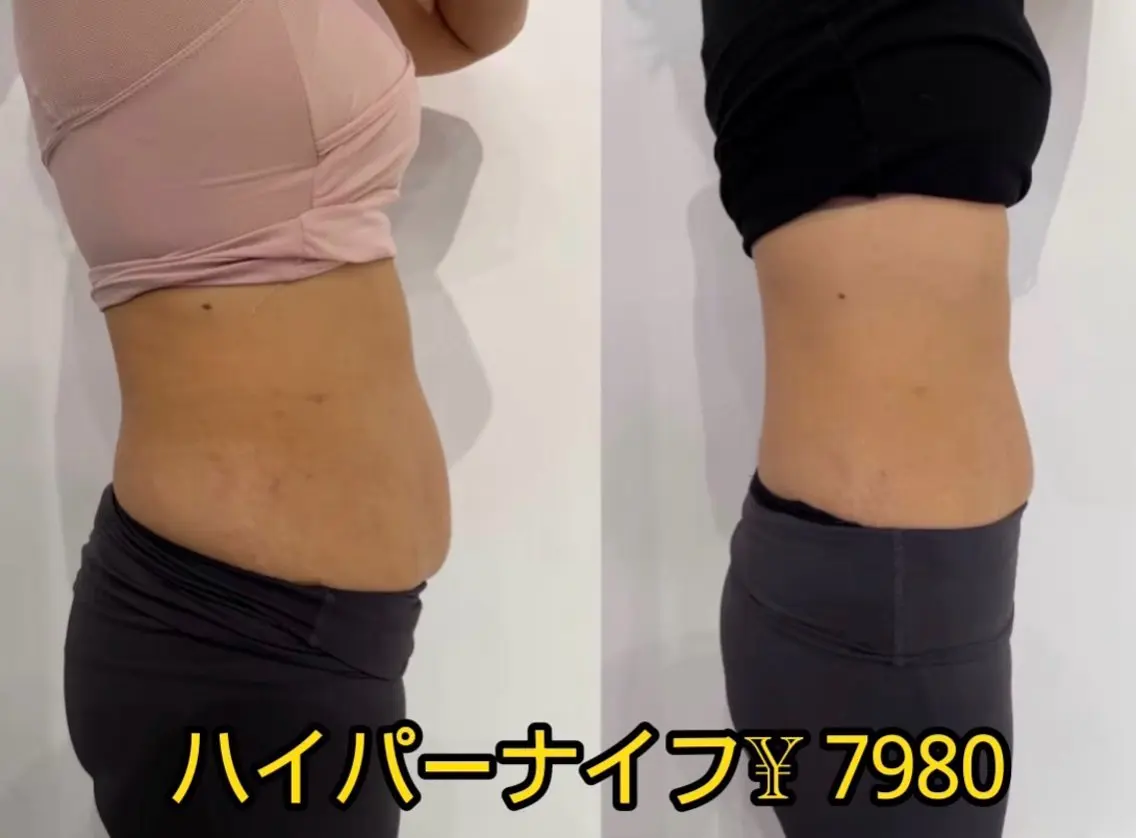 徹底痩身✨ハイパーナイフ&強カリンパたった1回でこの効果!セル脂肪溶かす➕むくみ徹底改善🦋の写真