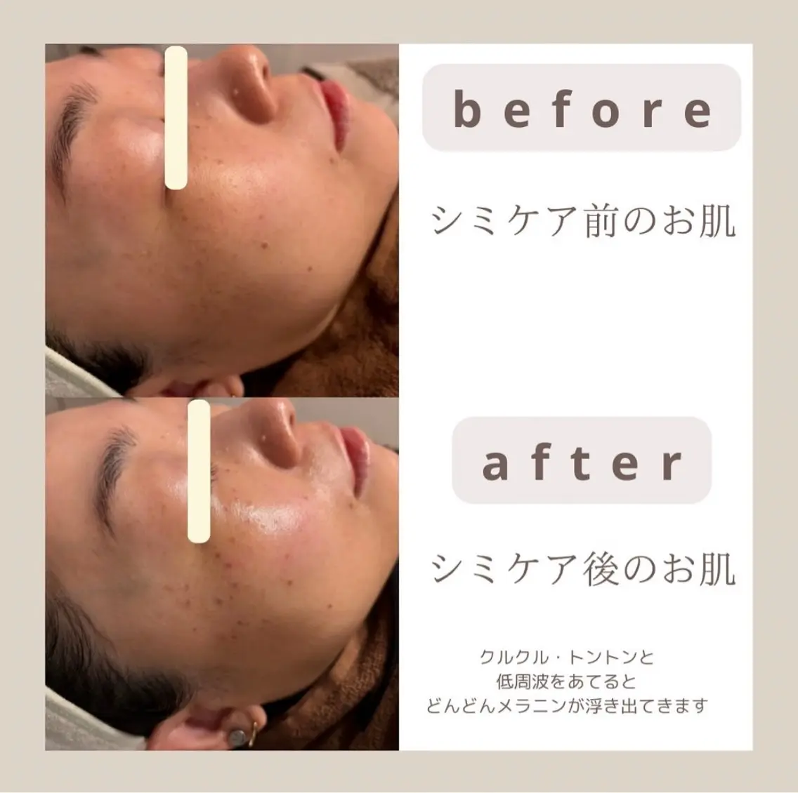 【premiumシミケアコース】の写真