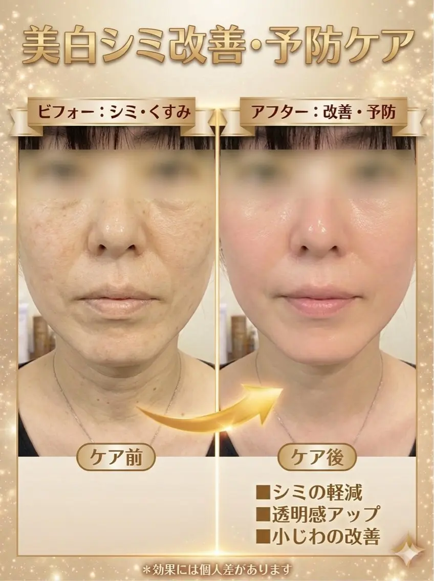 夏の紫外線ダメージケア 美白美肌美人への写真