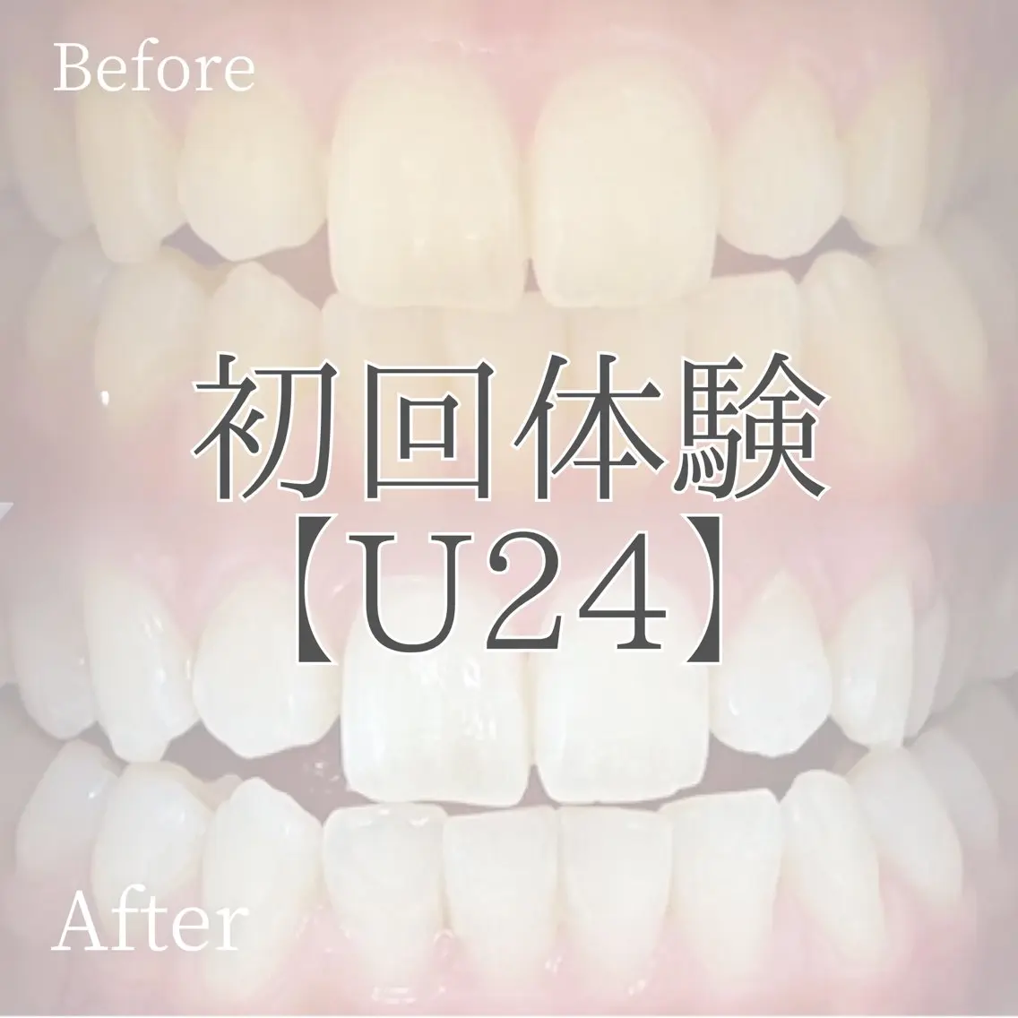 【ミニモ学割ホワイトニング🦷✨】おためし¥2,300✨2回目以降もコスパがいいからホワイトニング始めやすいです😊の写真