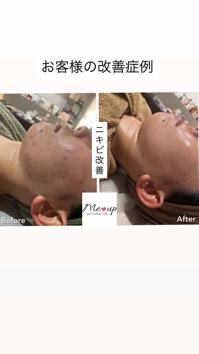 エステ Meup ニキビケア 毛穴・背中ニキビ専門のエステ・リラクイメージ