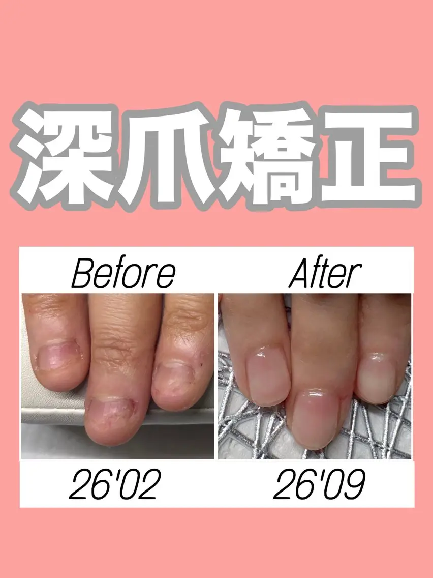 深爪矯正【長さ出し】◆カラーなし◆(オフ込)むしったり割れたり噛んで小さくなってしまった爪も美しく綺麗な状態に✧︎の写真