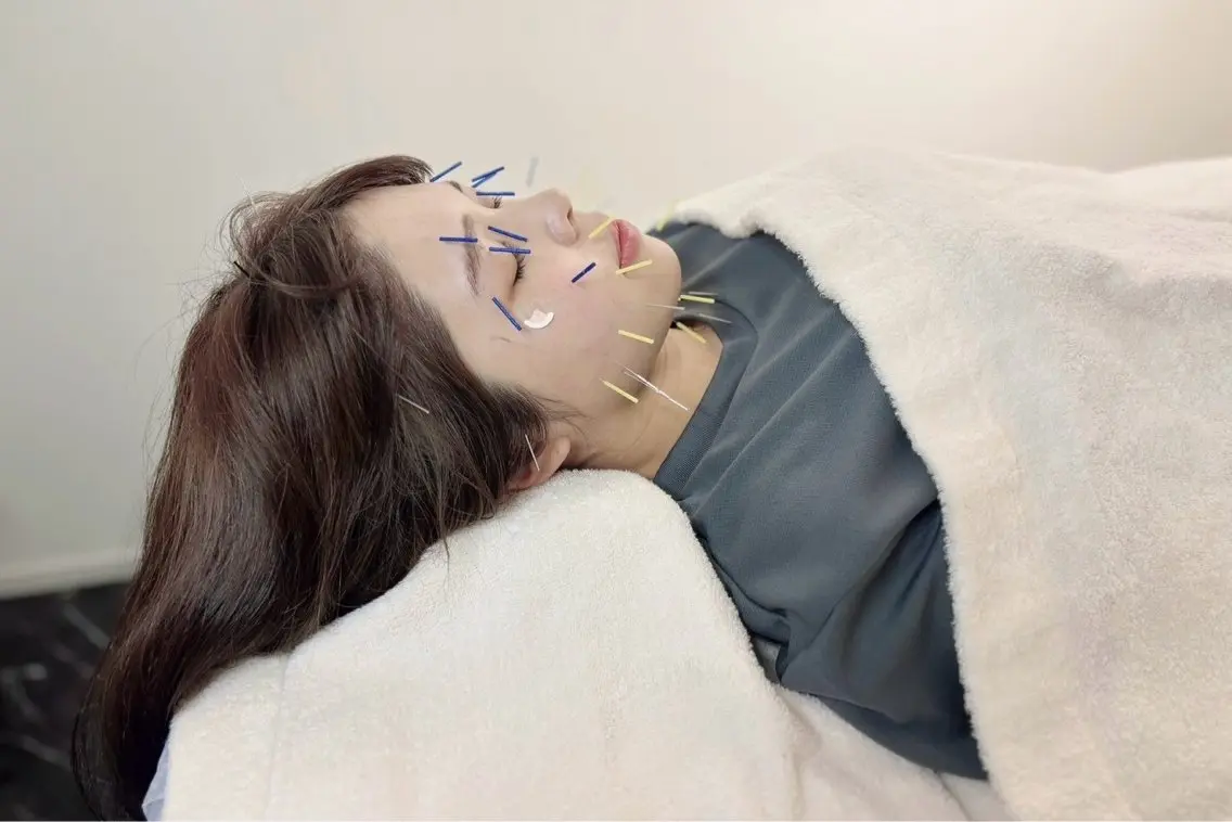 【オーナー施術確約】リフトアップ美容鍼首肩すっきりコースの写真