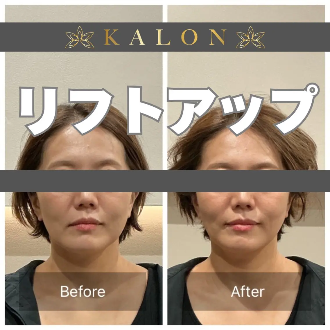 リラク 美容鍼×整体 KALONのその他イメージ