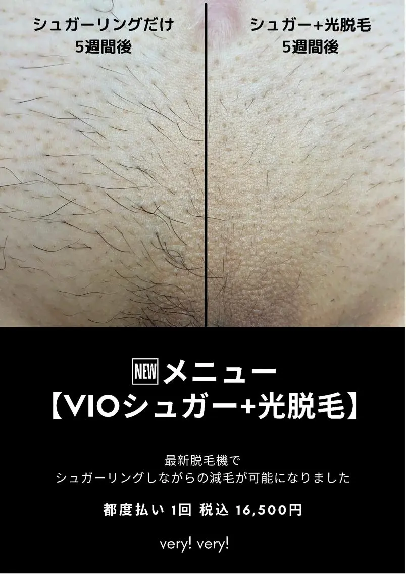 大人気!VIOシュガー+エステ脱毛:両ワキエステ脱毛付き【女性限定】の写真