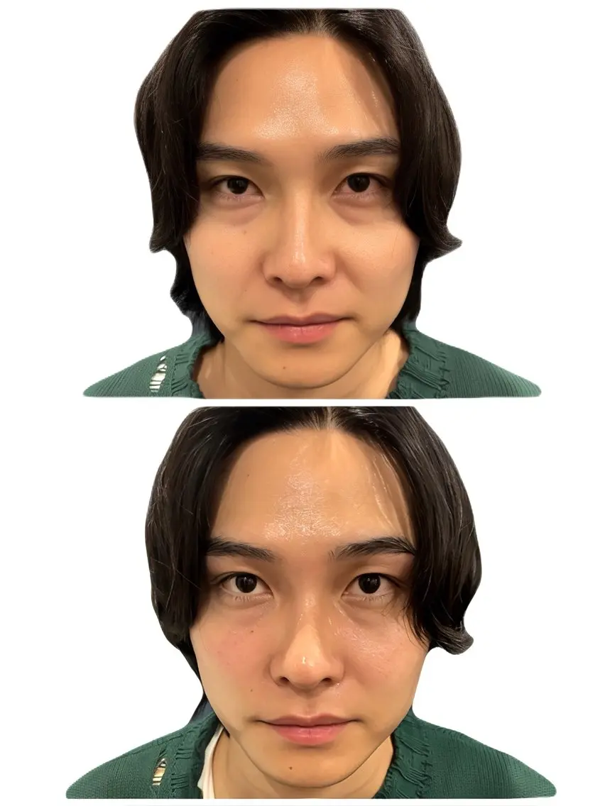 大人気‼️【お顔の脂肪もスッキリ✨】上記6step + 脂肪コントロール美容液導入7step 130分　初回9,900円の写真