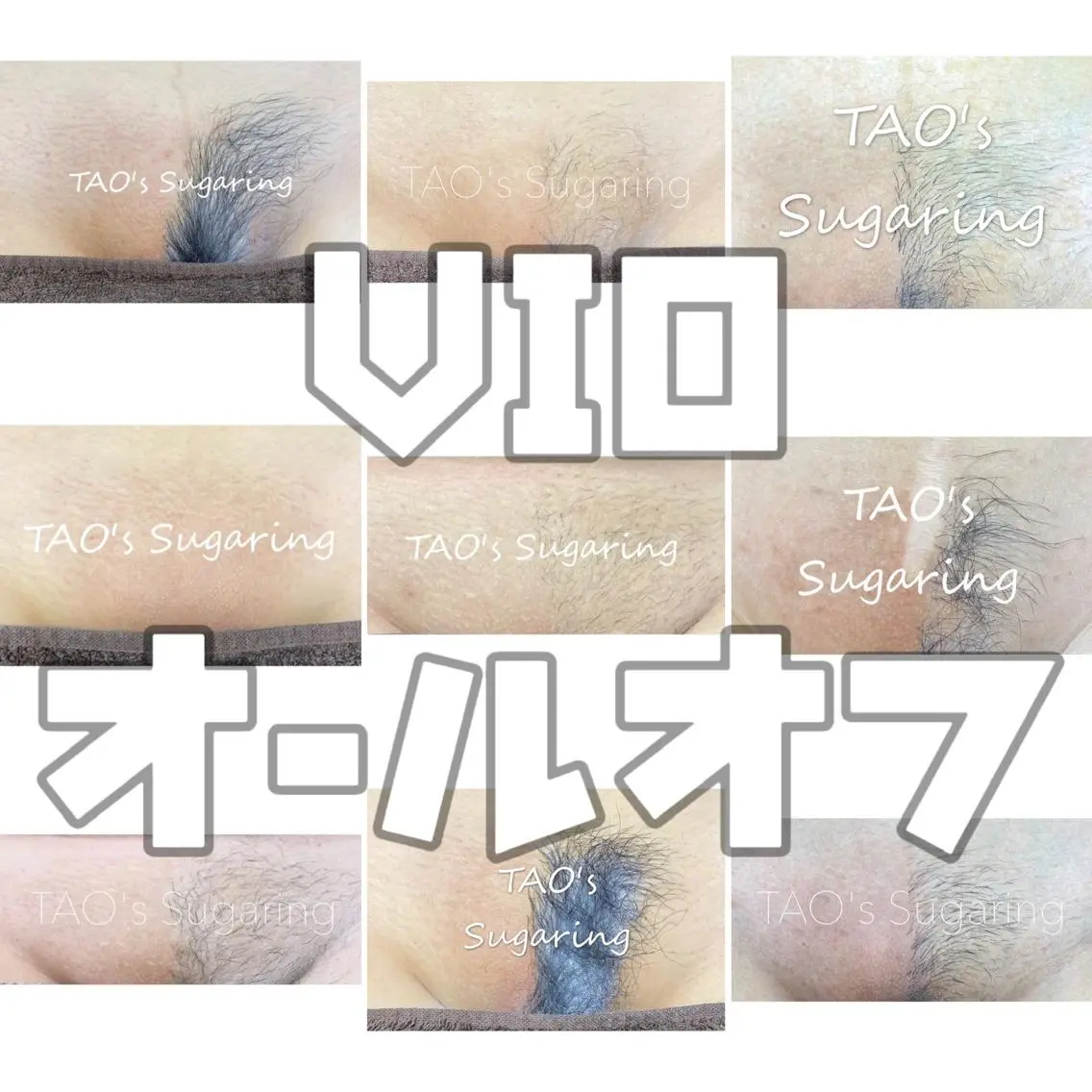 【Sugaring】VIOオールオフ/ブラジリアンの写真