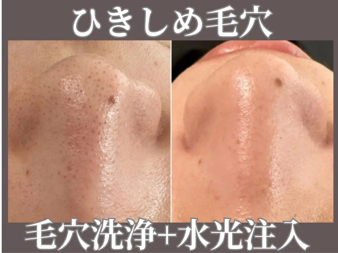 9/2 13時半開始15時終了の施術のみ募集【0円モデル】毛穴洗浄➕水光✨うるおい・ツヤ肌・小顔ケア、リフトアップの写真