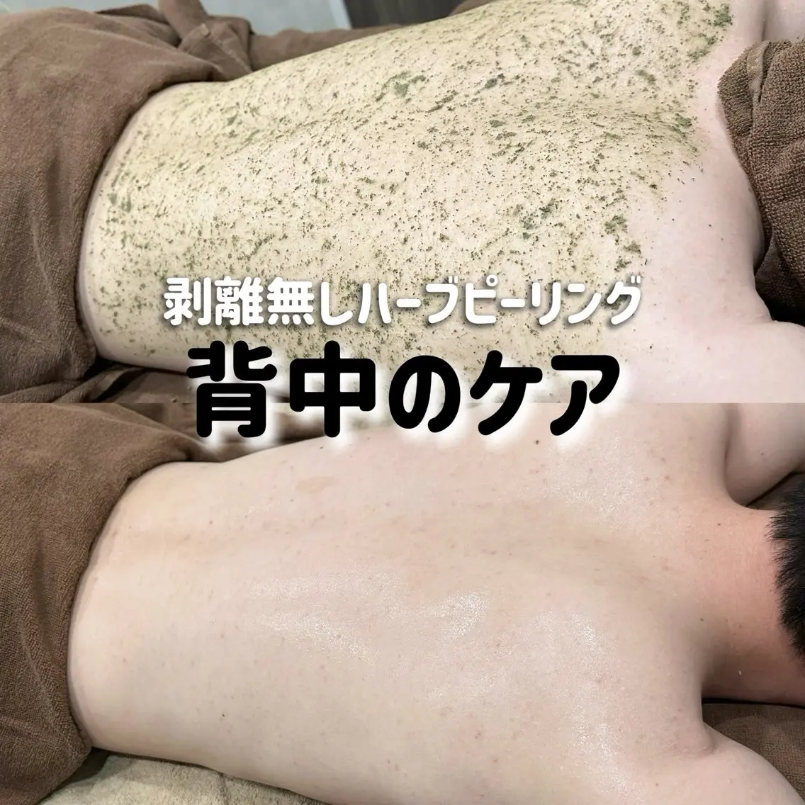 【背中半面or美尻or二の腕】ハーブピーリング🌿の写真