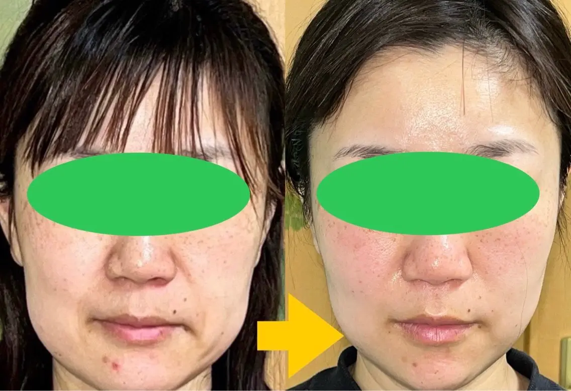【ミニモ学割U24】学生さん必見！小顔矯正＋美顔トリートメント60分　2000円の写真