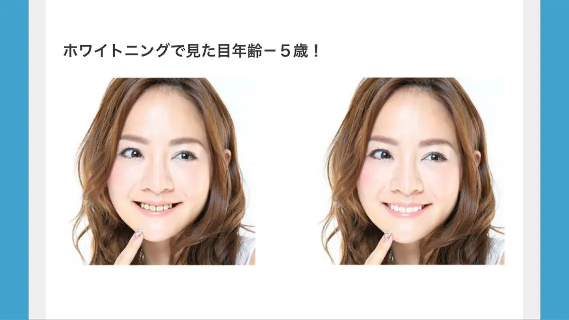 セルフホワトニングの写真