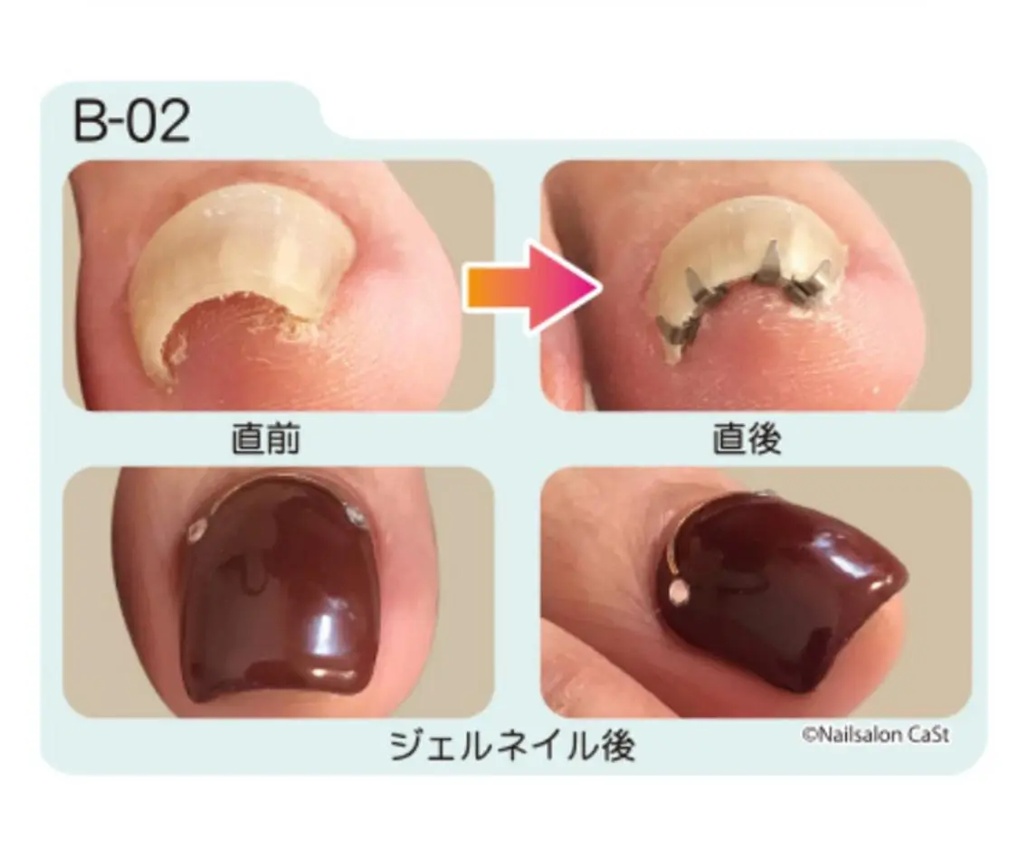 【✨巻き爪ケア2趾➕ジェルネイル🦶✨】(巻き爪リフト)ワンカラーorラメグラデーション】（※オフ無し）120分の写真