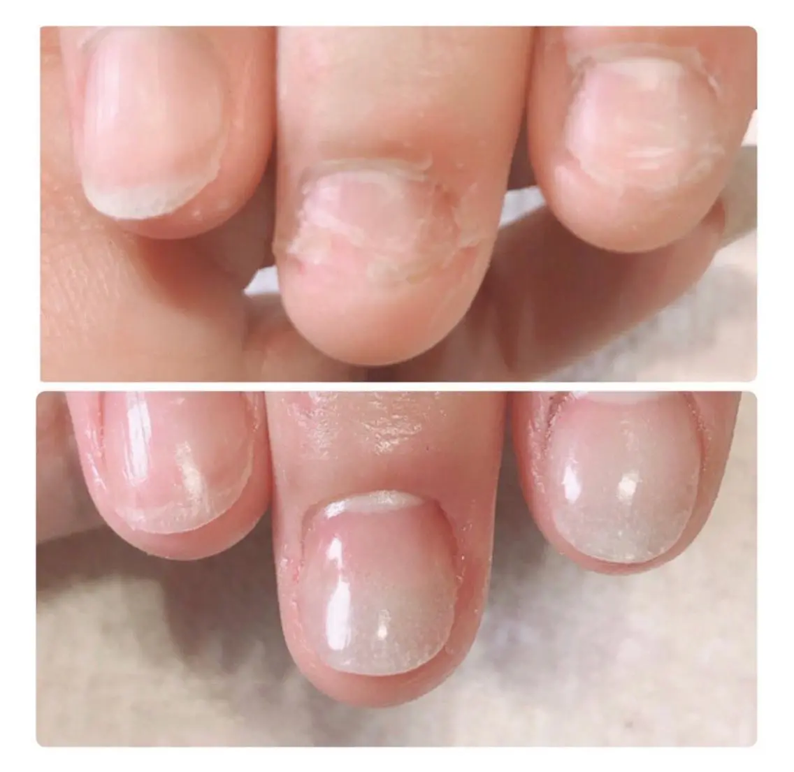 💕【深爪噛爪】矯正コース★長さ出しのみ(10本）*オフ無しの写真