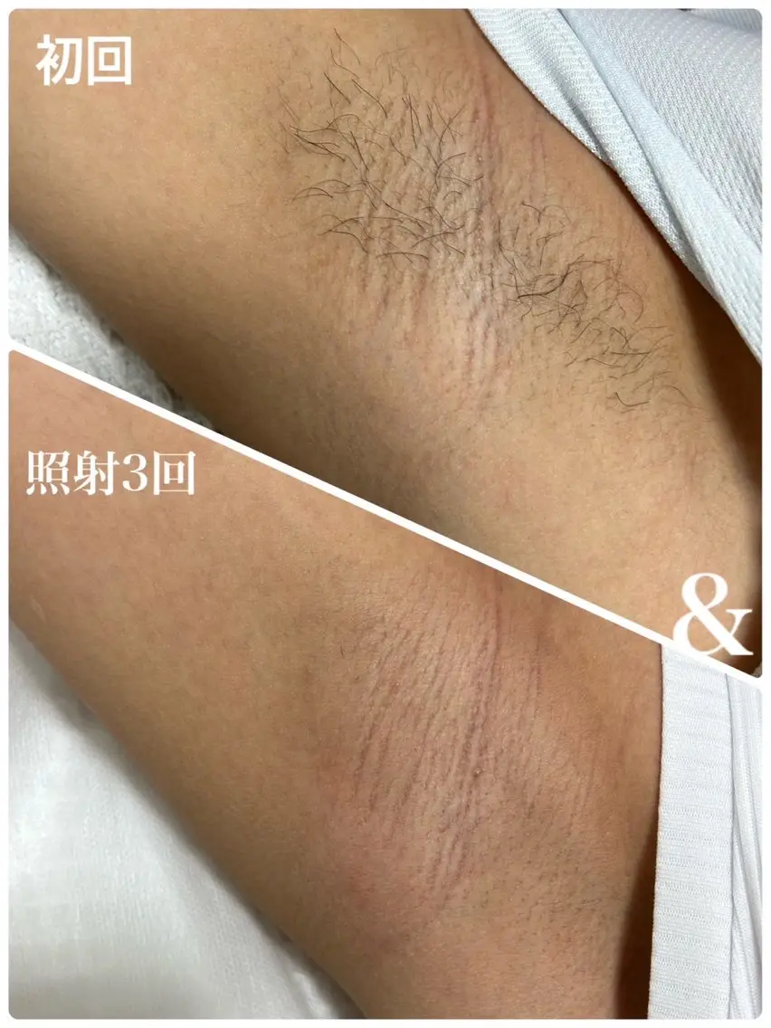 【やるしかないよね？】ワキ脱毛　初回　¥500の写真