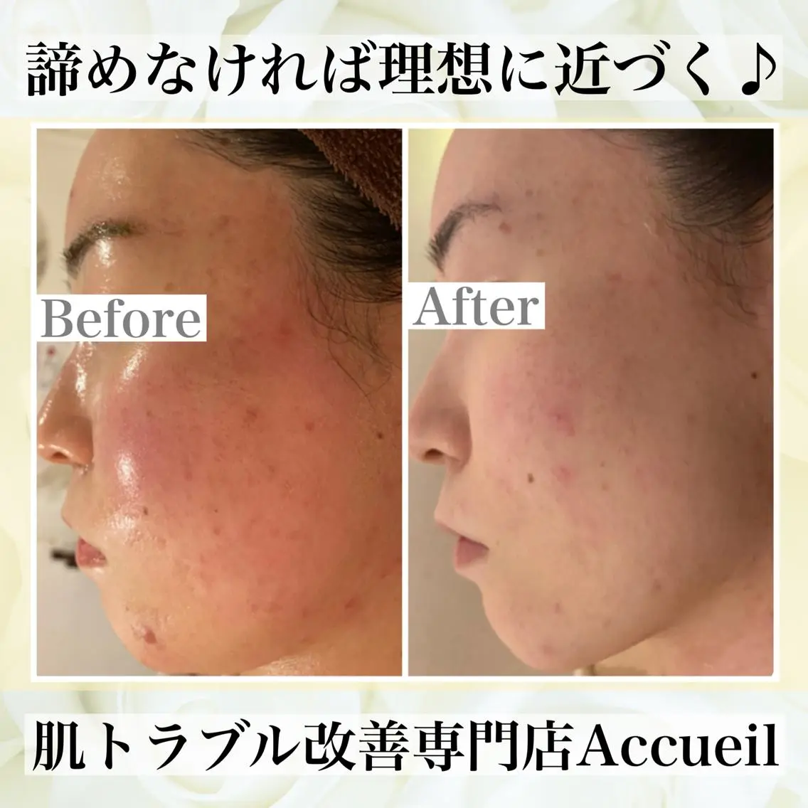 3か月で肌革命👼 ニキビ専門店💫のエステ・リラクイメージ