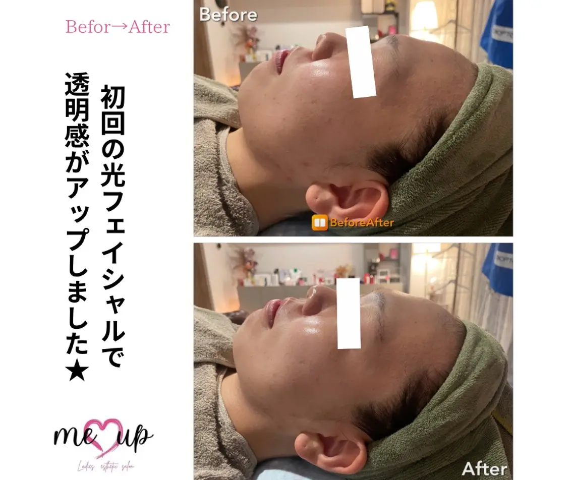 エステ Meupニキビ専門店 背中/ハーブ/肌管理のその他イメージ