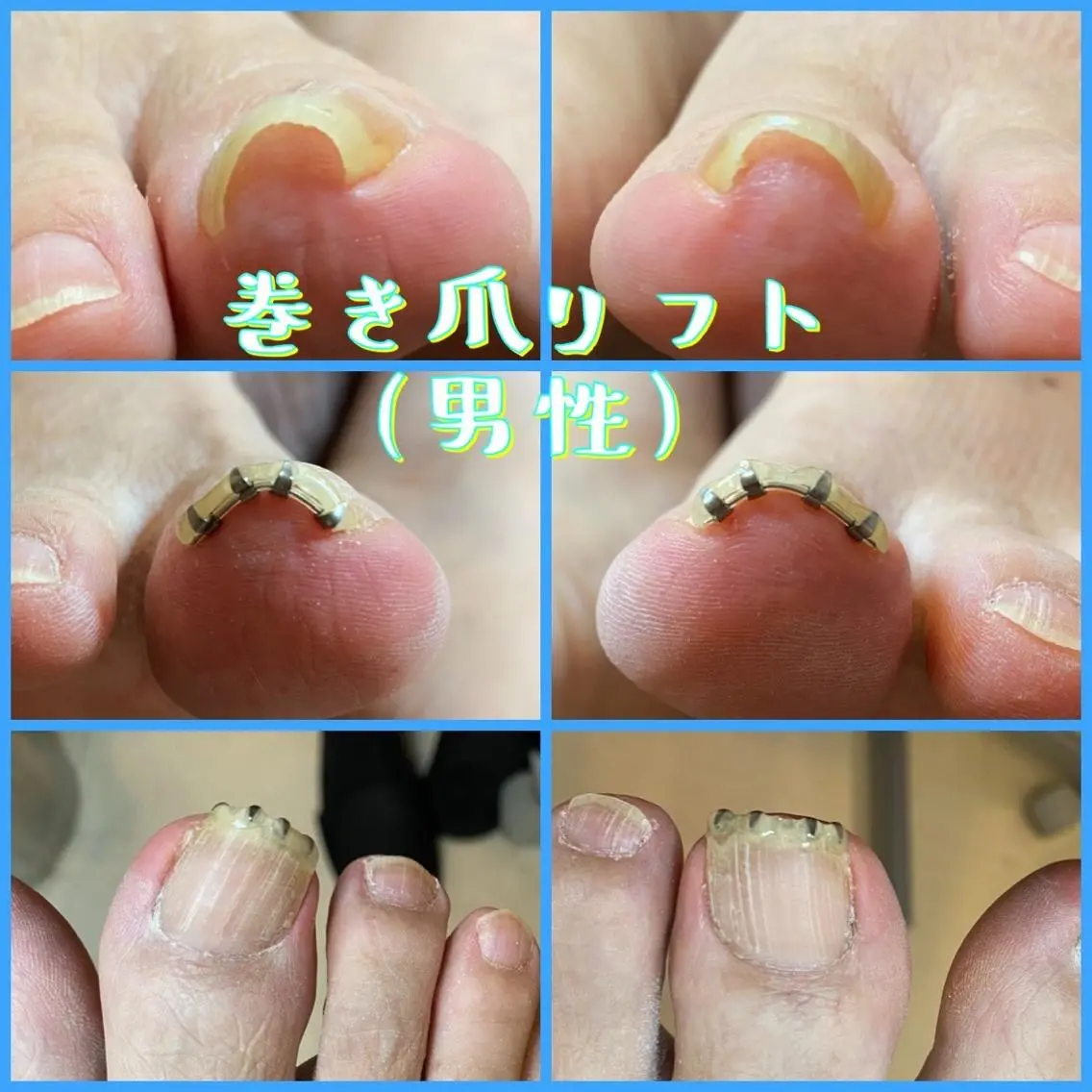 メンズ ネイル ジェルネイル ♢ME2ROOM♢ #巻き爪#リラクのネイルデザイン