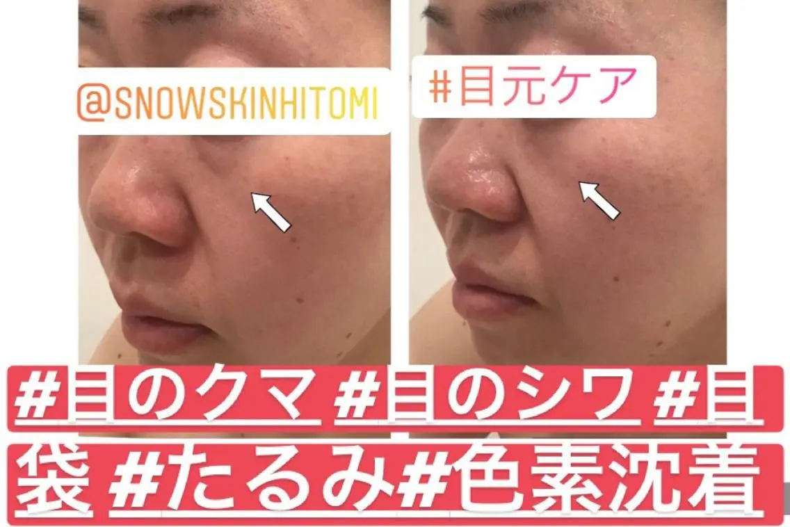 エステ リラク ニキビ/肌質改善専門 Snow skinのエステ・リラクイメージ